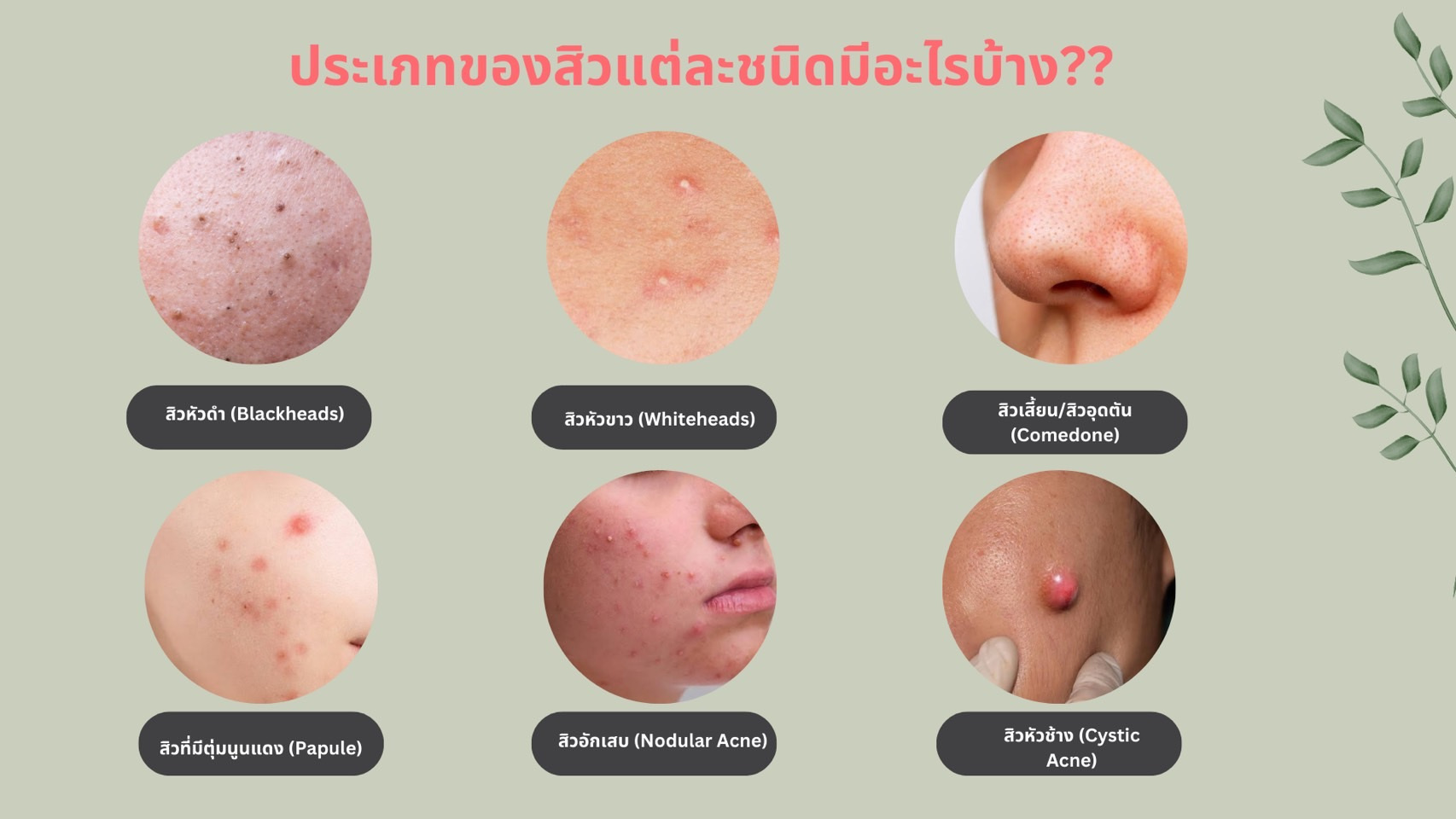 ประเภทของสิว-พร้อมวิธีจัดาร-3.jpg